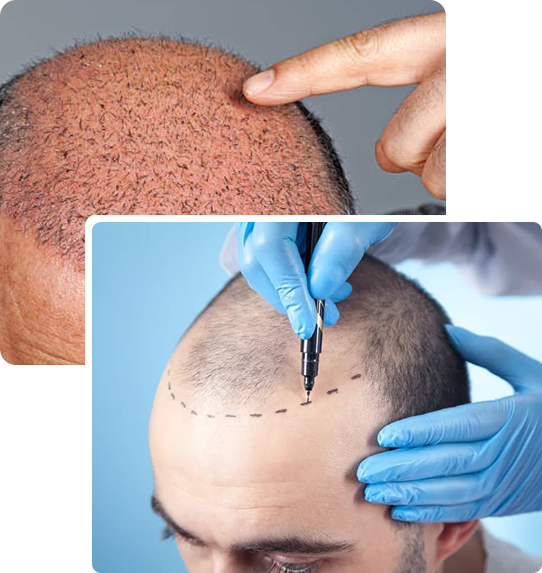 hair-transplant